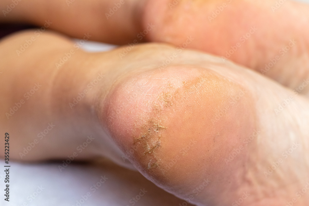 Fototapeta premium Cracks on the heel of a man