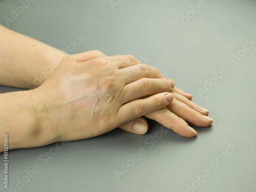 Vitiligo on hands on a gray background