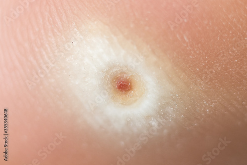 Plantar wart up close macro view.  Small hard thickened callus around wart head on heel of foot.  Verruca Plantaris solitary wart, after some topical treatments to reveal wart head.