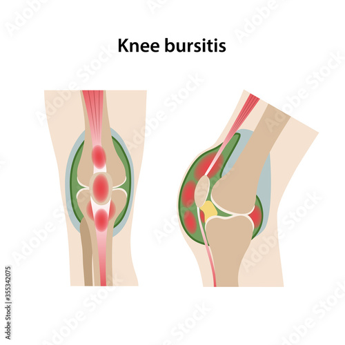 Bursitis of knee joint. Frontal and sagittal views of bursitis knees. Medical vector illustration in flat style isolated on white background