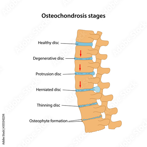 Stages of spinal osteochondrosis with main description: healthy disc, degenerative disc, protrusion, herniated, osteophyte formation. Medical vector illustration in flat style