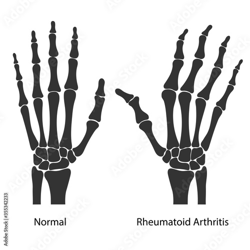 Rheumatoid arthritis of the human's hands. Black silhouettes of healthy and sore hands isolated on white background. Medical vector illustration