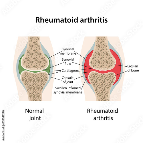 Rheumatoid arthritis of the joint. Image of healthy joint and diseased joint with main parts labeled. Medical vector illustration in flat style isolated on white background