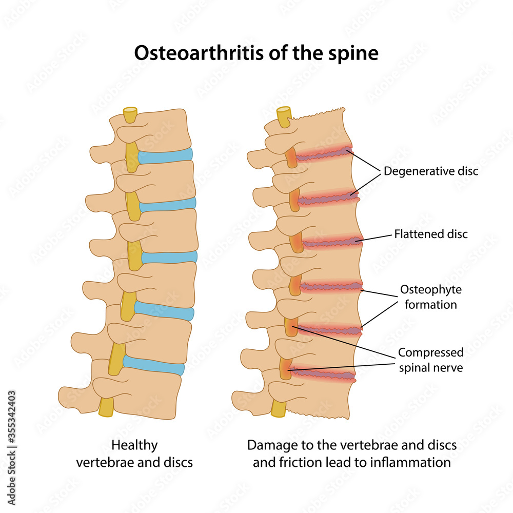 Osteoarthritis of the spine with main description. Healthy spine and ...