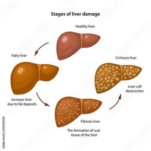 Stages of liver damage with description corresponding steps: healthy, fatty, fibrosis and cirrhosis liver. Anatomical vector illustration in flat style isolated over white background