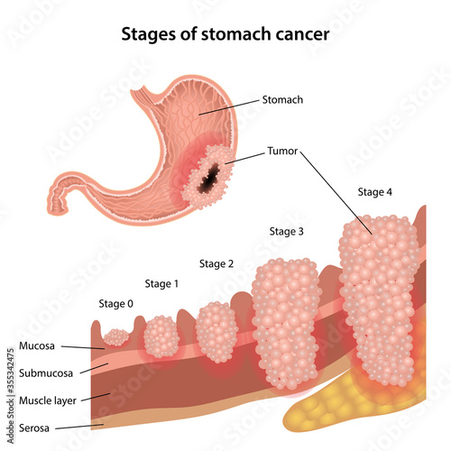 Stages of stomach cancer. Growth of cancer tumor growth. Anatomical vector illustration of the stomach with tumor and stages of stomach cancer isolated over white background.