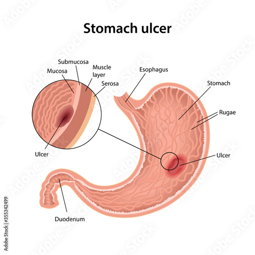 Stomach ulcer. Anatomical vector illustration of the stomach ulcer with description of the corresponding internal parts isolated over white background.
