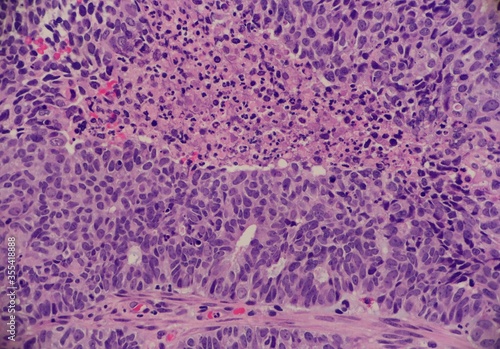 Foto Adenocarcinoma of the endometrium with solid areas and necrosis