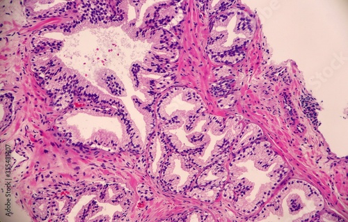 Benign hyperplasia of the prostate gland. Microscopic view.