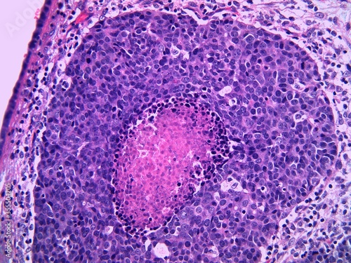 Detail of high grade urothelial carcinoma of the ureter in a man. The tumor has central necrosis which appears pink. Microscopic view. photo