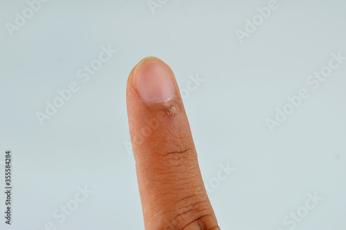 Finger with hangnail isolated on white background.