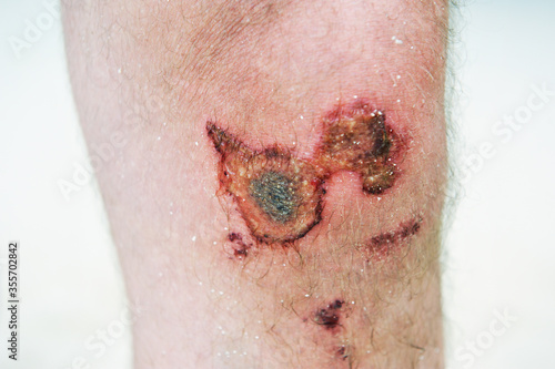 Photography Close up of red scab injury on man knee background