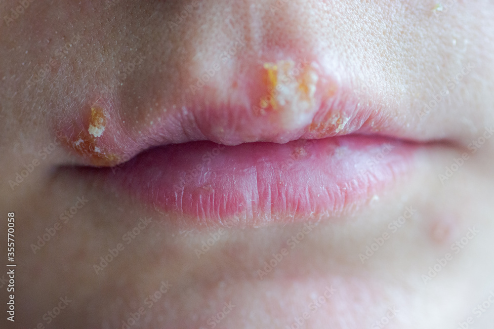 herpes-disease-on-the-lips-of-a-young-girl-wounds-from-herpes-on-the