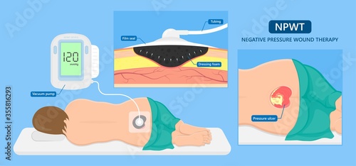 Vacuum assisted closure VAC drain tube treat dead damage pain medicine sealing healing diagnose exam technique surgery therapeutic suction high blood sugar test feet leg level loss air body Venous