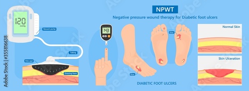 Vacuum assisted closure VAC drain tube treat dead damage pain medicine sealing healing diagnose exam technique surgery therapeutic suction high blood sugar test feet leg level loss air body Venous