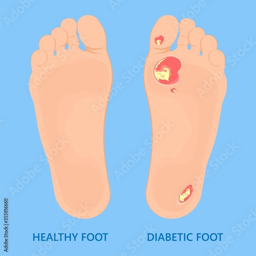 Vacuum assisted closure VAC drain tube treat dead damage pain medicine sealing healing diagnose exam technique surgery therapeutic suction high blood sugar test feet leg level loss air body Venous