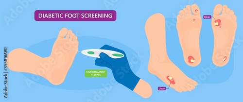Vacuum assisted closure VAC drain tube treat dead damage pain medicine sealing healing diagnose exam technique surgery therapeutic suction high blood sugar test feet leg level loss air body Venous