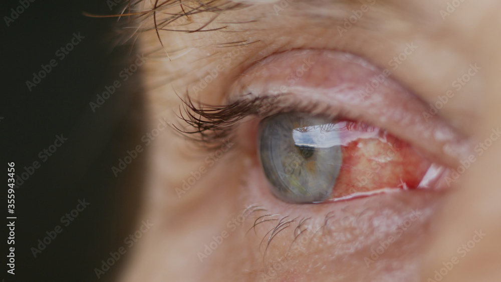 close up. woman eye with burst capillaries, cataract surgery. - obrazy, fototapety, plakaty 