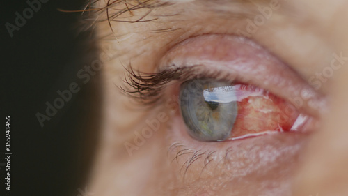 close up. woman eye with burst capillaries, cataract surgery. photo