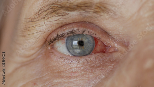 close up. elderly woman eye with burst capillaries, cataract surgery.