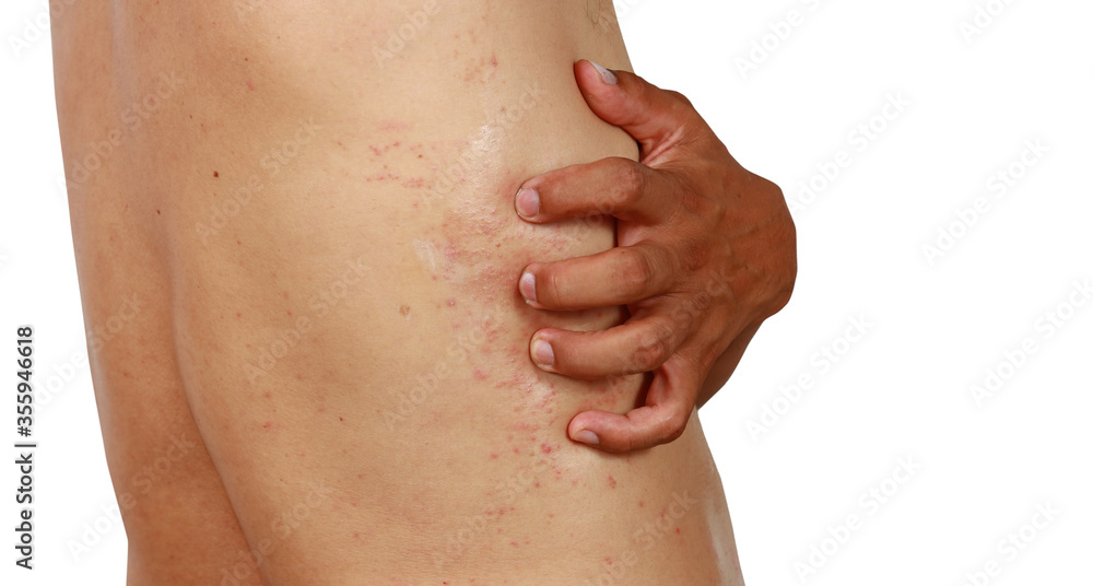 A man show red rash on his back A man show red rash on his back