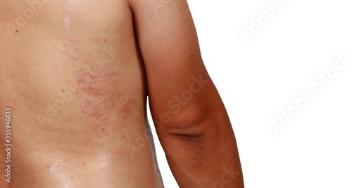 A man show red rash on his back