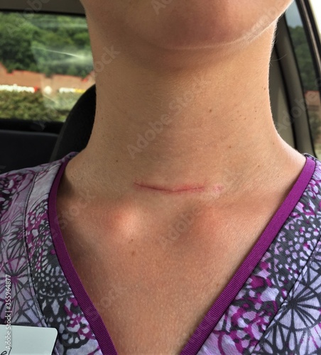 A healing scar on a woman's neck from thyroidectomy surgery due to papillary thyroid cancer 