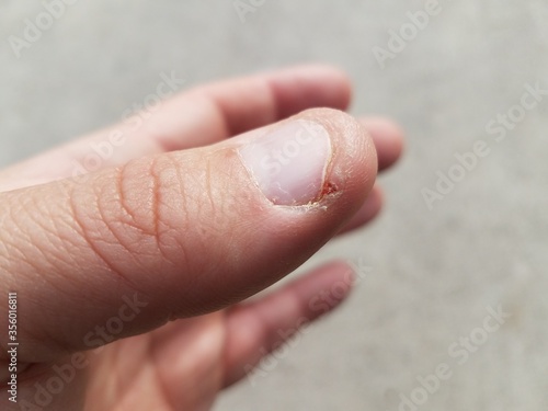 thumb on hand with short fingernail and small cut or blister © Justin
