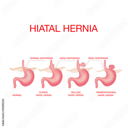Hiatal hernia. Vector diagram of Normal anatomy and sliding hiatal hernia. photo