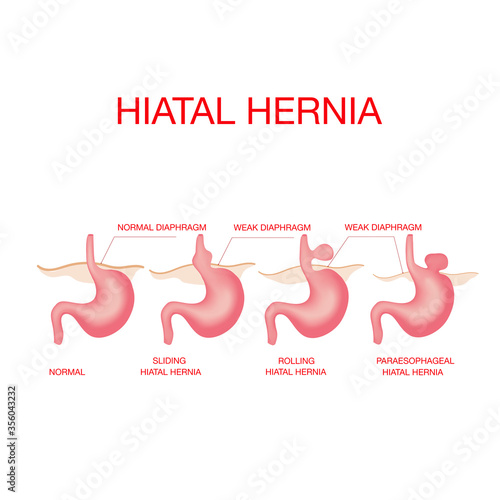 Hiatal hernia. Vector diagram of Normal anatomy and sliding hiatal hernia.