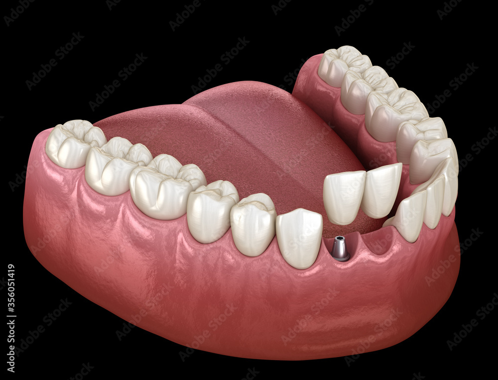 Cantilever bridge implant based, frontal tooth recovery. Medically accurate 3D animation of