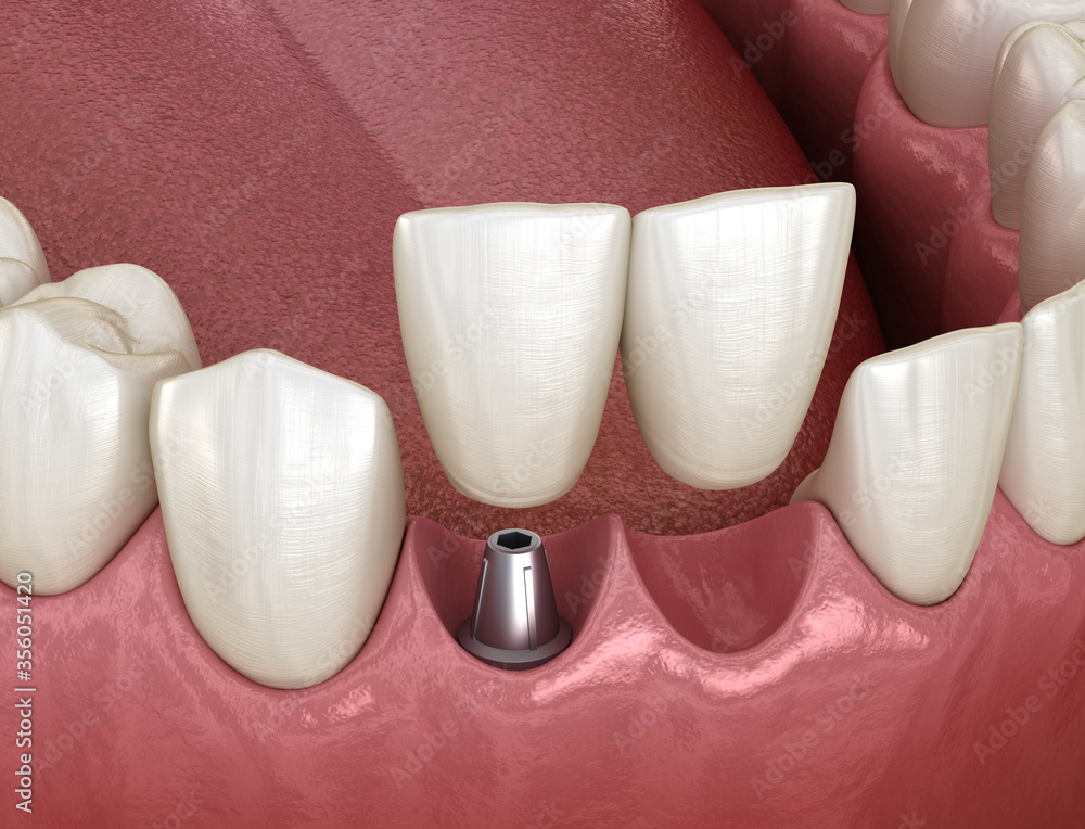 Cantilever bridge implant based, frontal tooth recovery. Medically accurate 3D animation of