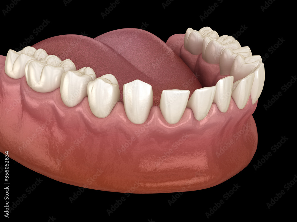 Fototapeta premium Excessive Spacing between teeth. Dental 3D illustration concept