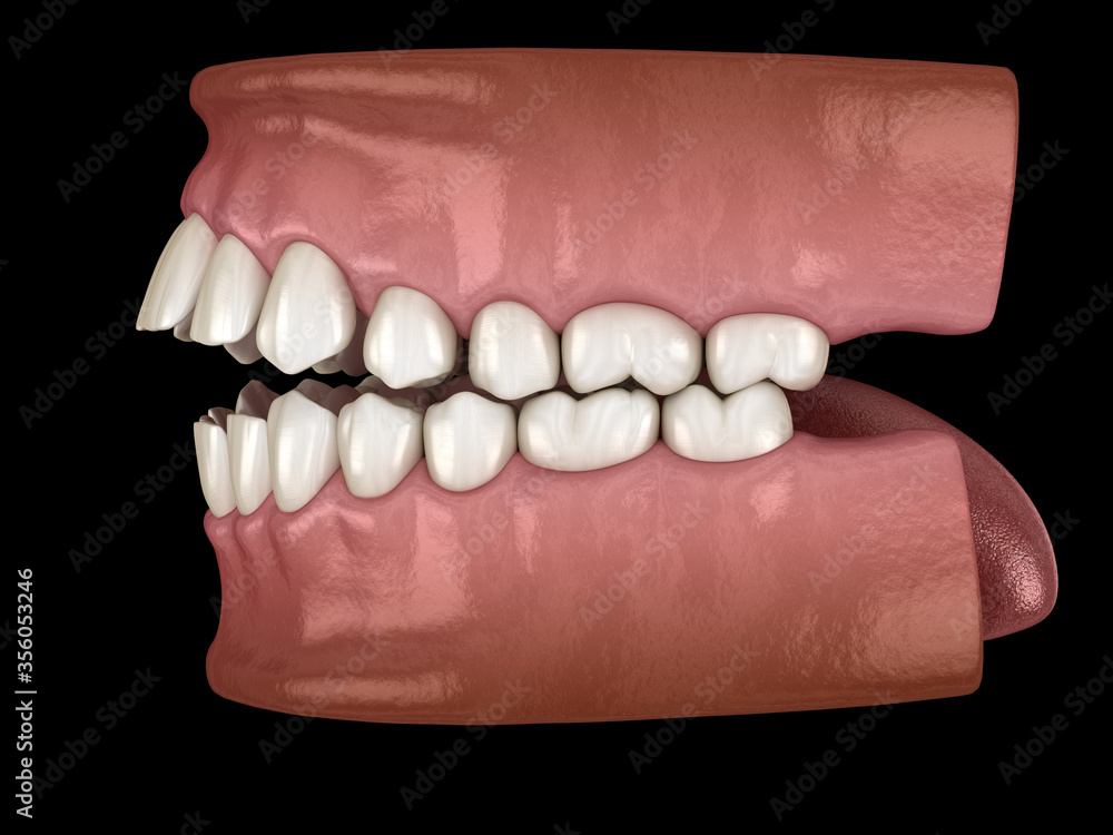 Openbite dental occlusion ( Malocclusion of teeth ). Medically accurate