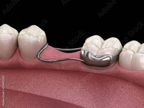 Space Maintainer Unilateral keeps from teeth shift deformatiuon after losing molar tooth. 3D illustration photo