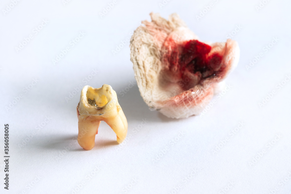 Removed Root Canal Treatment teeth are caused by cracked crowns on a white background with gauze and blood. Removed Root Canal Treatment teeth are caused by cracked crowns on a white background with gauze and blood.