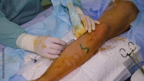 The surgeon is performing an radiofrequency ablation (RFA) procedure. Varicose vein treatment. Vascular surgery.