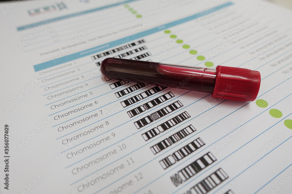 Blood for chromosome testing in laboratory Blood for chromosome testing in laboratory