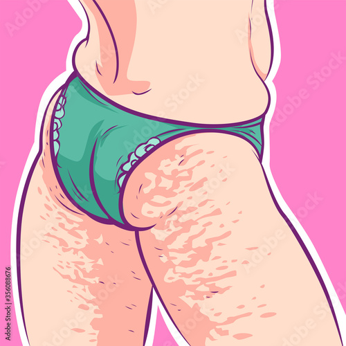 Woman hips with cellulite, vector illustration
