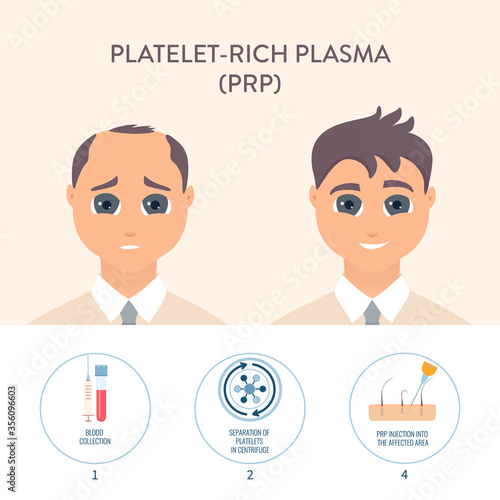 Hair loss treatment by PRP therapy. Stages of platelet-rich plasma restoration procedure for men. Health care and medical concept. Vector illustration.