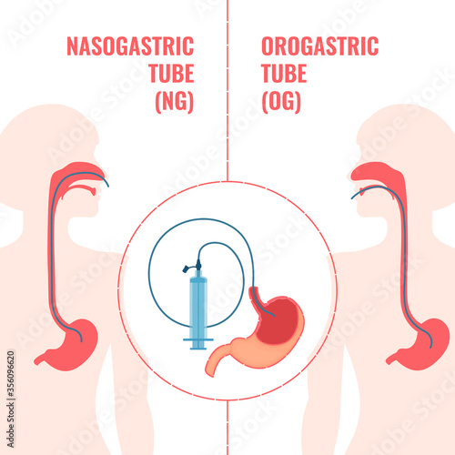 Gastrointestinal system infographics. Nasogastric and orogastic tubes passed through nose and mouth to stomach. NG and OG enteral feeding tubes. Emergency medical concept. Vector illustration.
 photo