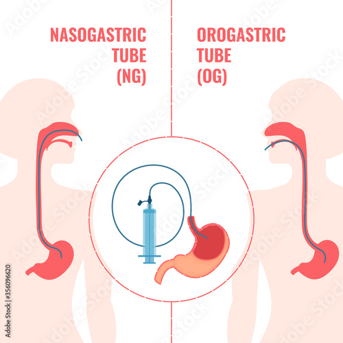 Gastrointestinal system infographics. Nasogastric and orogastic tubes passed through nose and mouth to stomach. NG and OG enteral feeding tubes. Emergency medical concept. Vector illustration.
