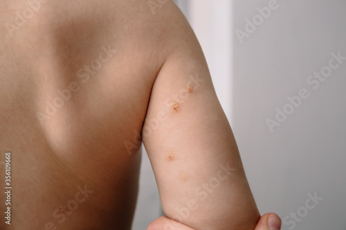 Close-up of Molluscum Contagiosum also called water wart. Treated viral formations on the skin of a child's hand. photo