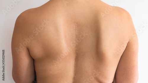 Caucasian woman's upper back with a scar.