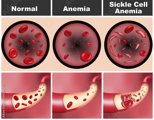 Quadro su tela 3D illustration of normal human blood vessel with flowing red blood cells versus