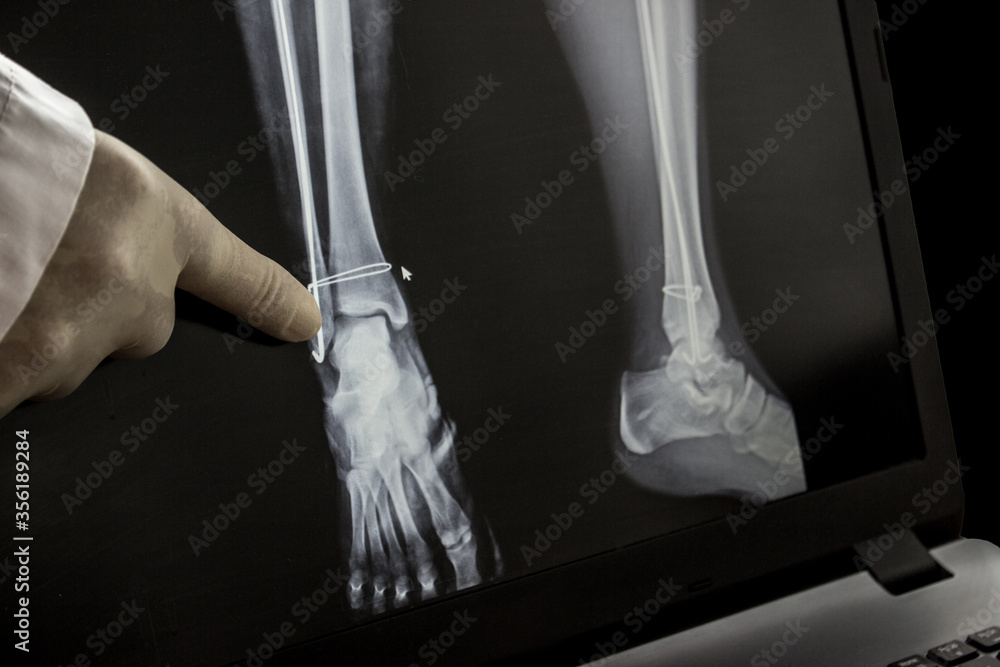 Naklejka premium X-ray after operation for the leg