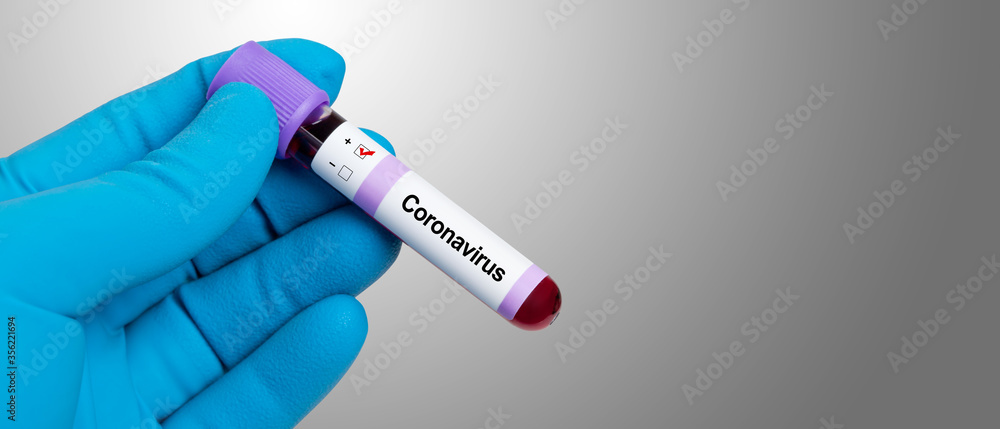 Obraz premium Coronavirus 2019-nCoV Blood Sample.
