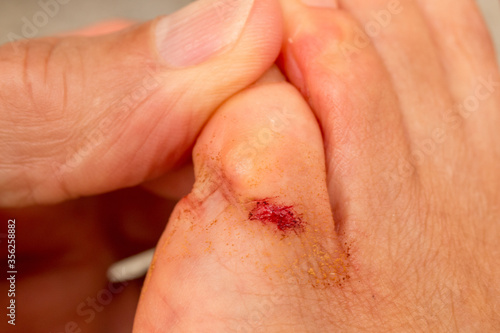 Person with a Small Bloody Cut on the Little Toe   