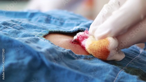 Cutting skin in man's back for ambulatory surgery in selective focus