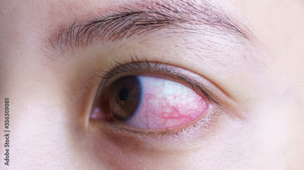 Obraz premium Red bloodshot eye of woman, irritated or infected, conjunctivitis eye or after cry.